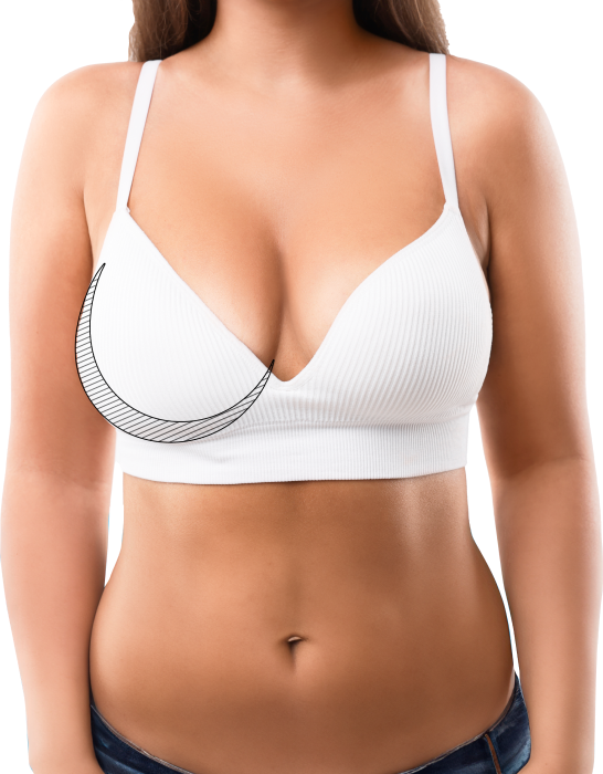Breast Reduction Surgery