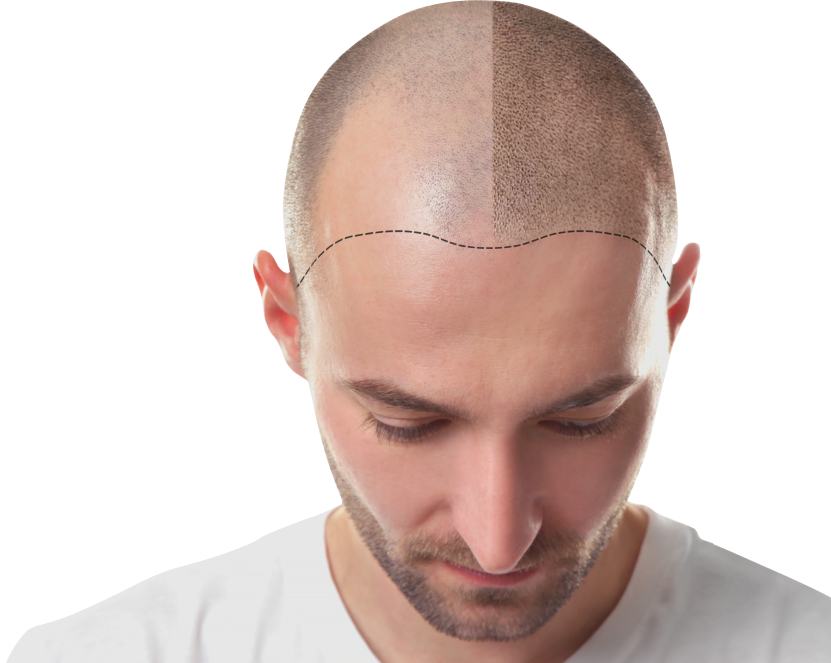 DHI Hair Transplant