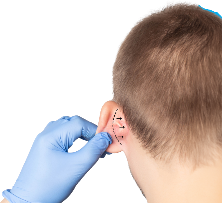 Otoplasty Surgery