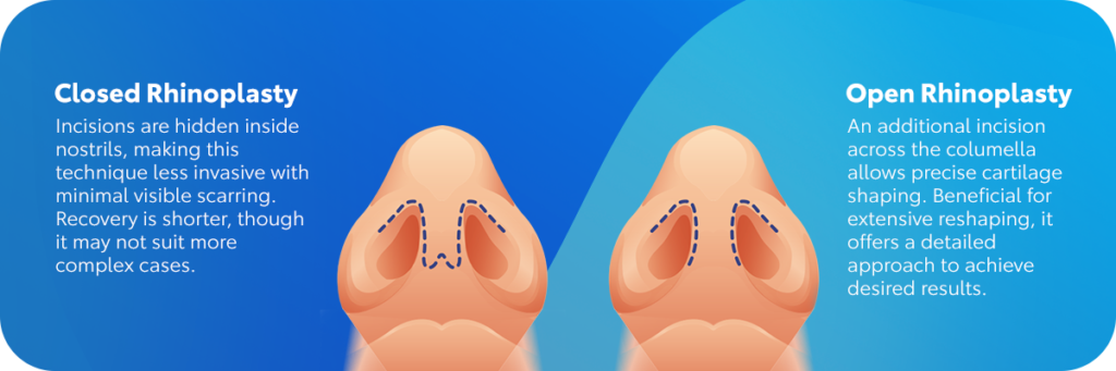 what-is-closed-and-opend-rhinoplasty